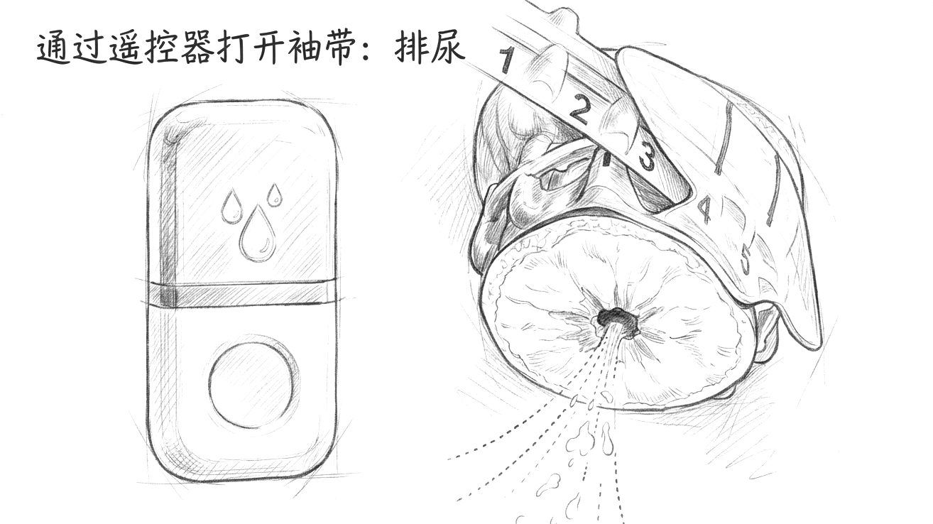 铅笔素描风格示意图:袖带松开瞬间,尿液正常流出膀胱